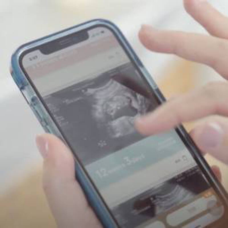 多囊試管，懷上龍鳳胎！職場女性試管備孕2.5次終圓夢