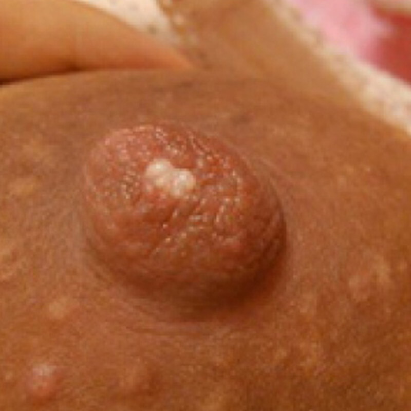 乳頭小白點10大處理方法！哺乳塞奶、乳腺阻塞不再來