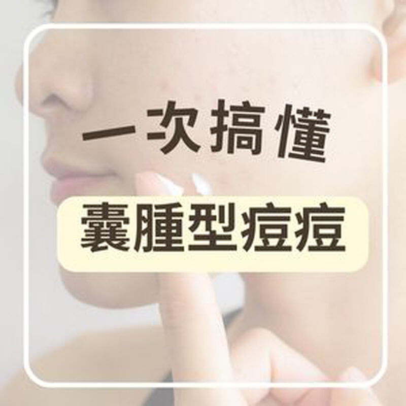 囊腫型痘痘怎麼消？多久會好？藥膏成分與預防全解析